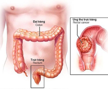 Phẫu thuật điều trị ung thư trực tràng